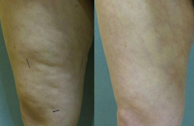 Cellulaze before and after