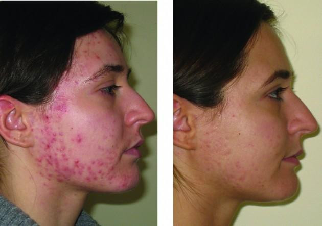 Before and after skin accumax
