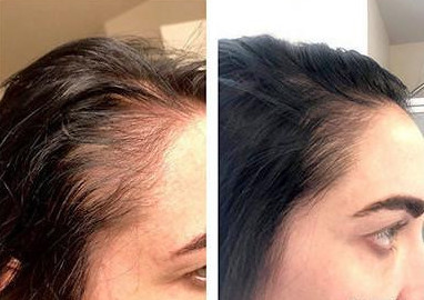 before and after nutrafol hair loss and thinning