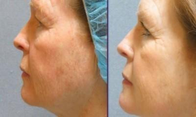 Combination Facial Resurfacing Treatments
