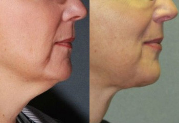 Before and after laser lipo neck lift