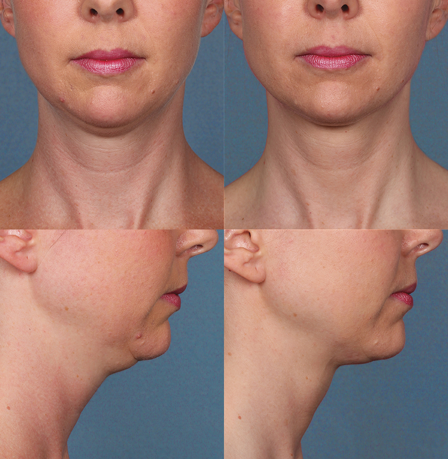 Before and after Kybella neck fat treatment