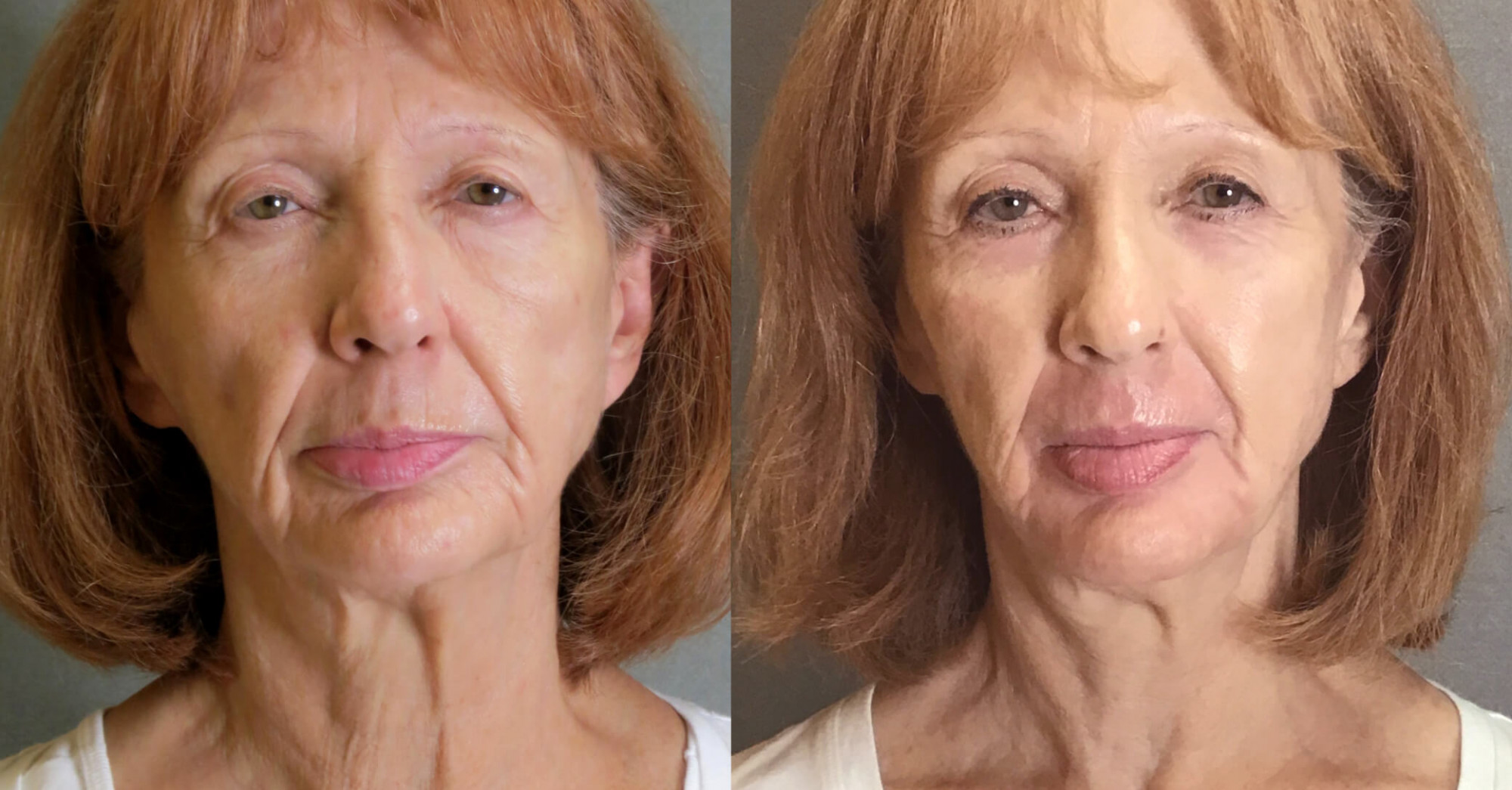 Before & After Gallery | QnA Cosmetic Surgery & Medical Spa