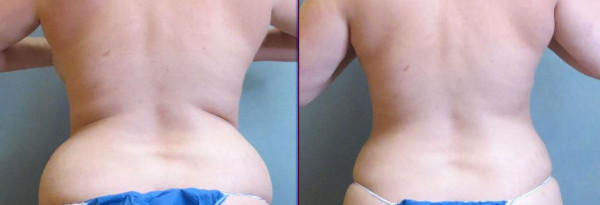 Flank Liposuction Before and After - Glow Aesthetic Medicine